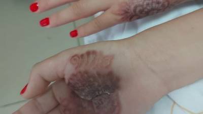 Девочка в Израиле сделала татуировку хной, и у нее чуть не отнялись руки - vesty.co.il - Израиль