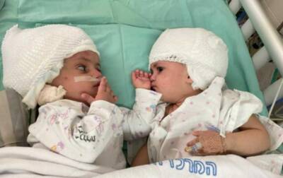 В Израиле успешно разделили сиамских близнецов - korrespondent.net - Израиль - Украина - Беэр-Шева