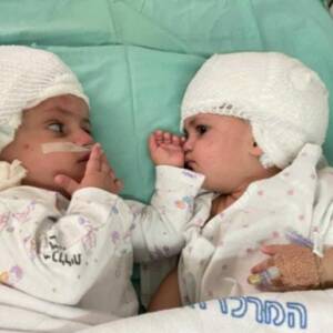 В Израиле врачи успешно разделили сиамских близнецов. Видео - reporter-ua.com - Израиль - Беэр-Шева - Видео