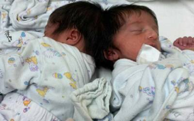 «По две головы»: в Израиле впервые разделили головы сиамских близнецов (фото, видео) - sharij.net - Израиль - Видео