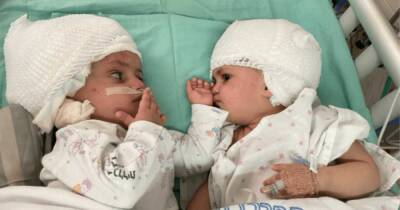 "Они смотрели друг на друга": в Израиле хирурги разделили сиамских близнецов - focus.ua - Израиль - Украина - Беэр-Шева