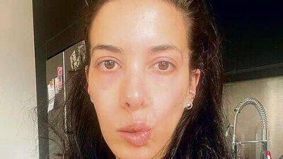 Молодая журналистка посмотрела в зеркало и остолбенела: у нее парализовало лицо - koronavirus.center - Израиль
