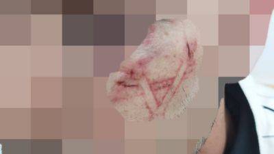 Жалоба: полицейские нацарапали магендавид на щеке арестованного араба - vesty.co.il - Израиль - Иерусалим