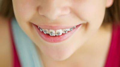 В каком возрасте лучше начинать выпрямление зубов в Израиле - vesty.co.il - Израиль