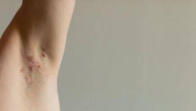 Неприятная кожная болезнь в Израиле: гнойный гидраденит. Как это лечат - vesty.co.il - Израиль