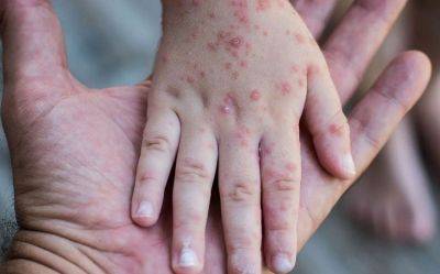 Минздрав Азербайджана призывает граждан пройти вакцинацию от коревой инфекции - trend.az - Азербайджан