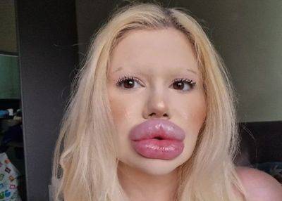Девушка с самыми огромными в мире губами принялась за нос - mignews.net - Болгария