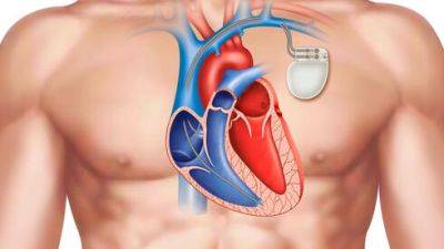 Прорыв в медицине Израиля: установка кардиостимулятора без операции - vesty.co.il - Израиль - Сша